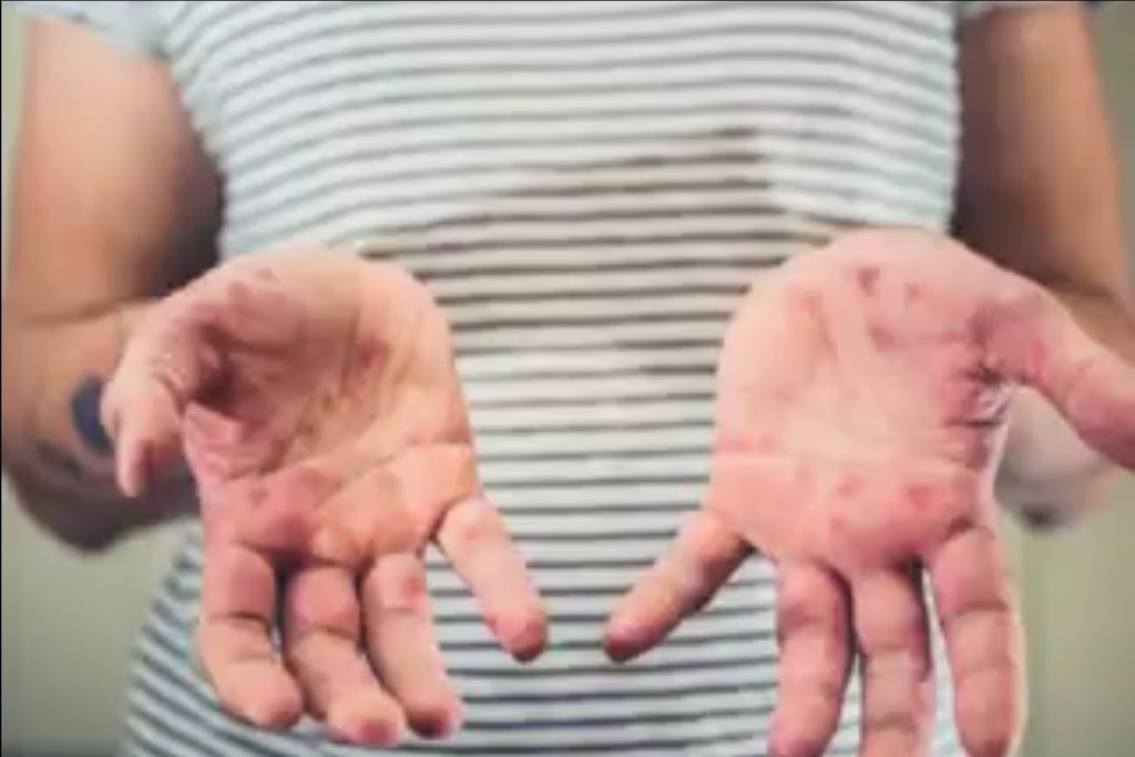 Vigilance Urged as Hand, Foot and Mouth Disease&nbsp;Spreads