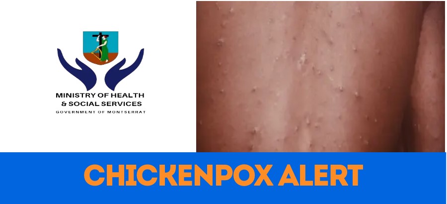MONTSERRAT: Chickenpox Identified On&nbsp;Island
